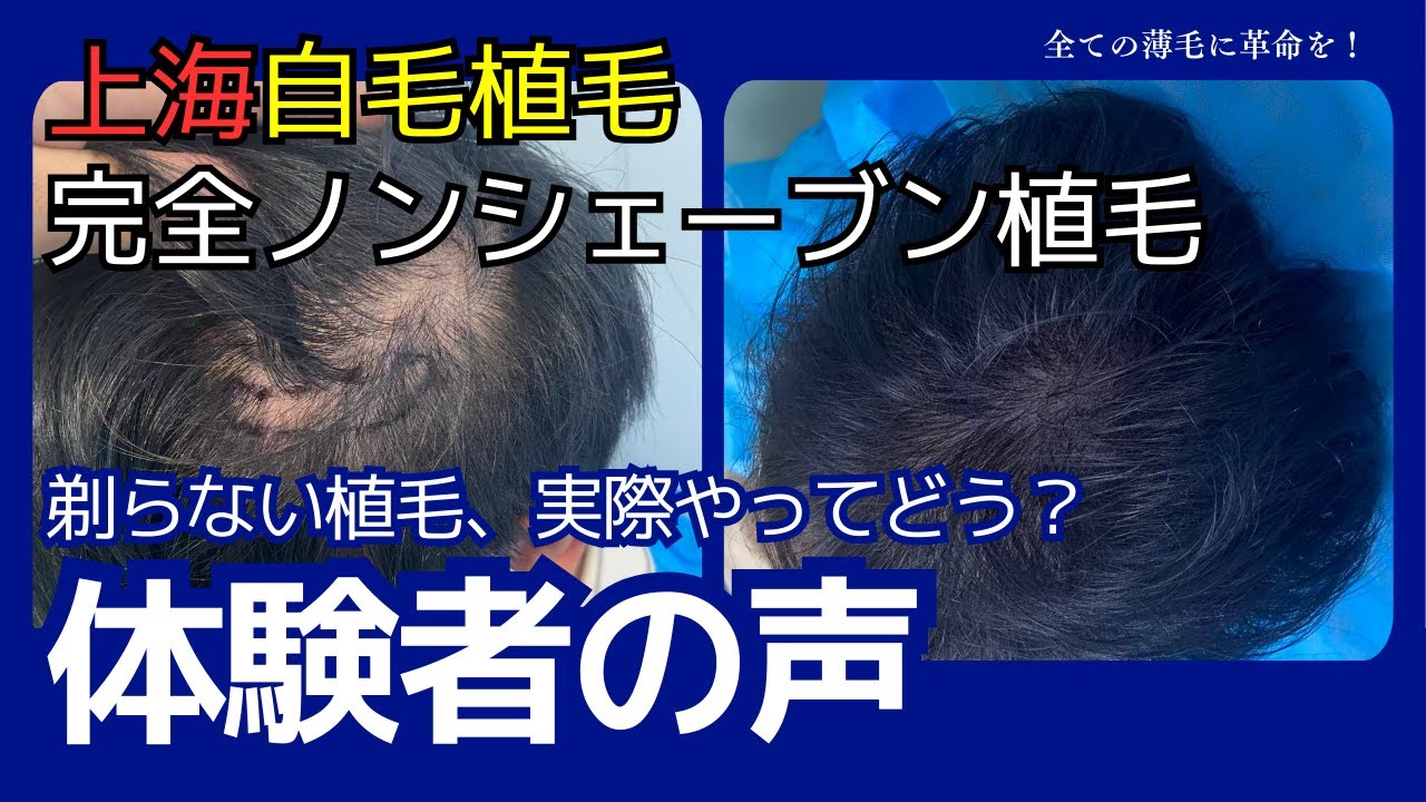 完全ノンシェーブン植毛ビフォーアフター完全解説！体験者様の生の声が聴けるインタビュー付き！