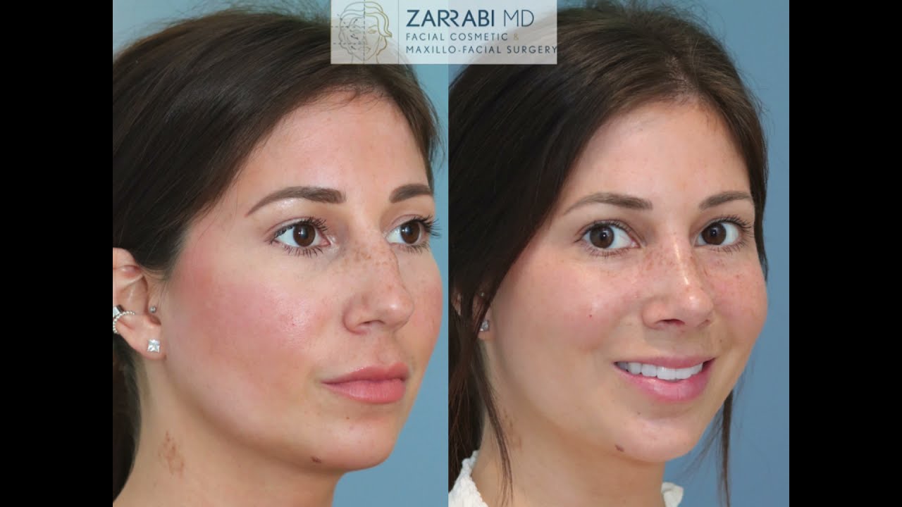 Closed Piezo Preservation Rhinoplasty
