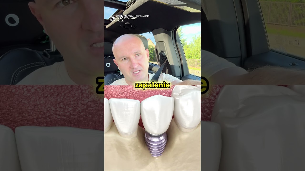 IMPLANT z DIODĄ LED? 💡🦷 Dentysta: REWOLUCJA, kt&oacute;ra WYTĘPI BAKTERIE! (To NIE SCIENCE-FICTION!)