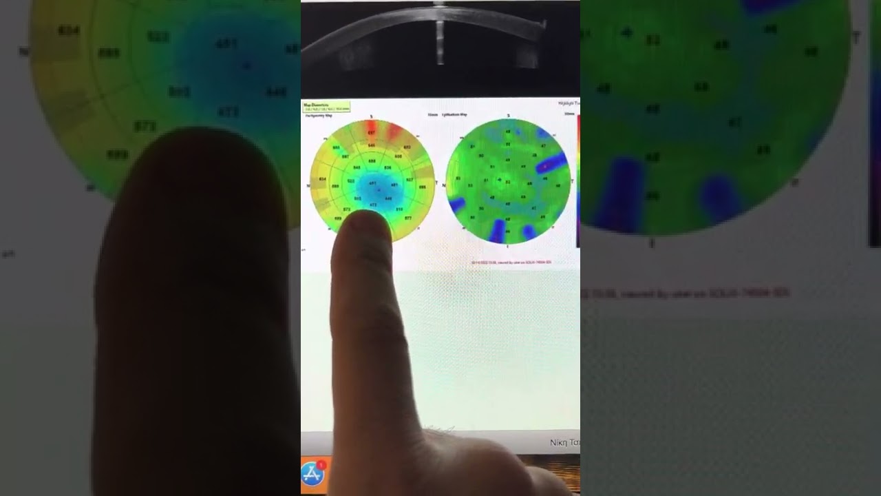 Late haze  1.5 years after CXL for keratoconus 22yearold male: images & management, Kanellopoulos MD