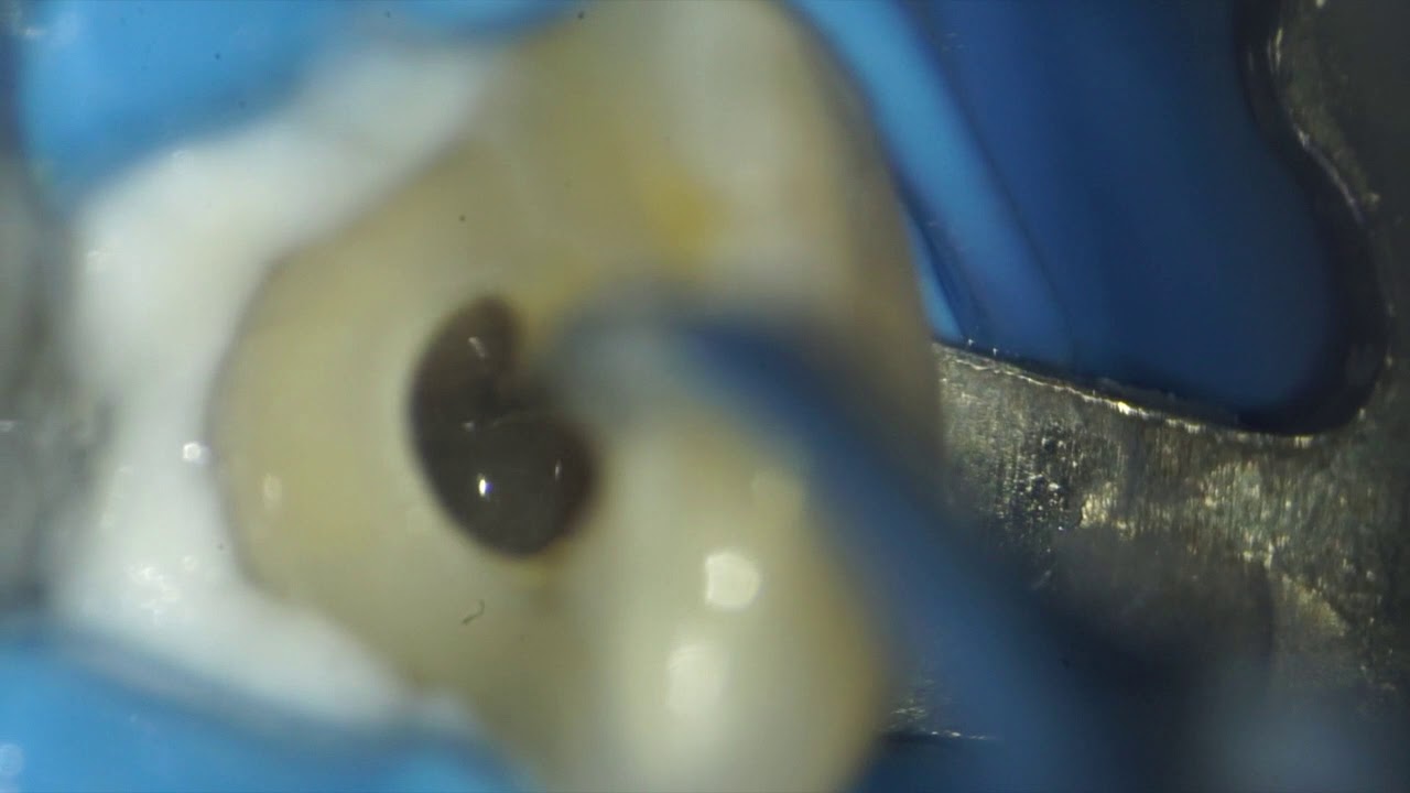 Obturation with MTA(apical plug of MTA)