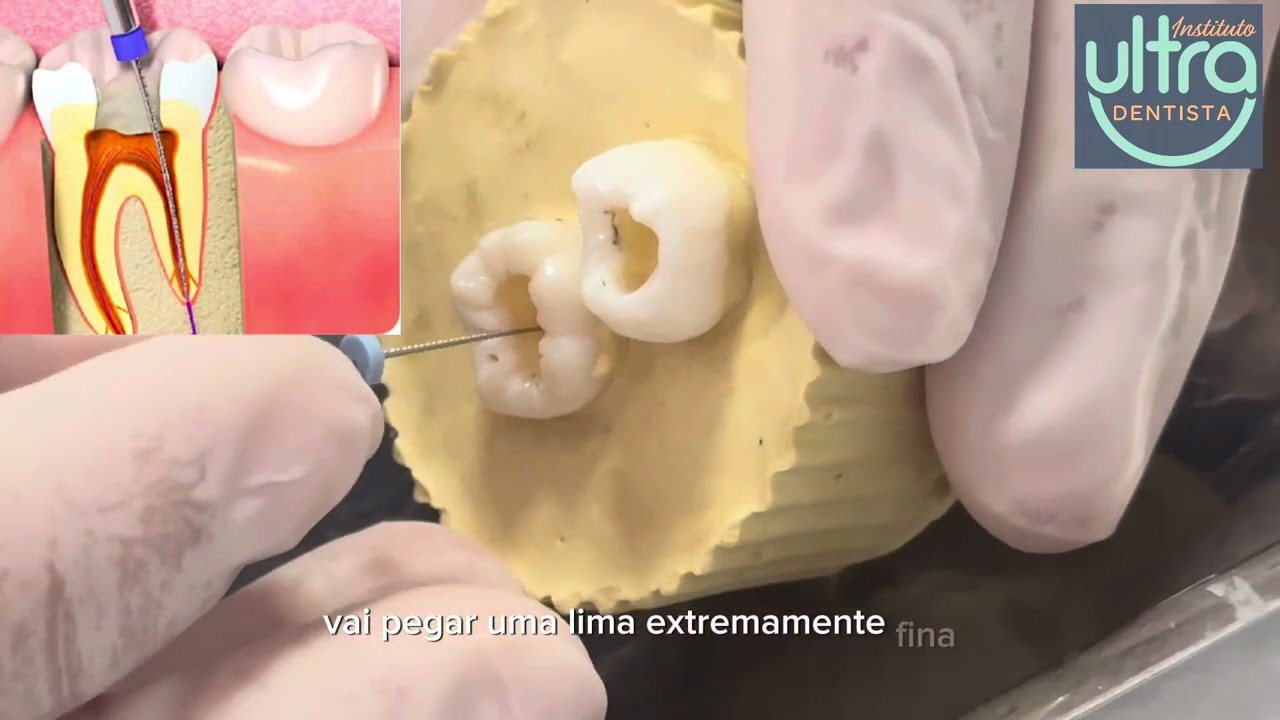 Saiba como fazer uma Emergência Endodôntica no seu Paciente