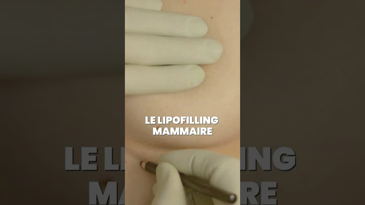 Les b&eacute;n&eacute;fices insoup&ccedil;onn&eacute;s du lipofilling mammaire