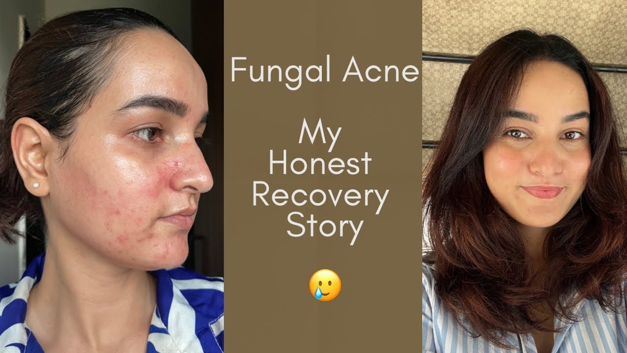 Fungal Acne Took My Confidence|Here’s How I Took It Back✨
