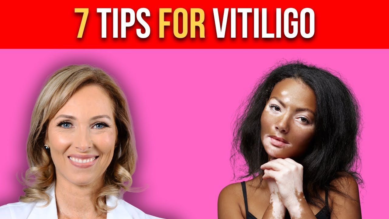 7 TIPS FOR VITILIGO
