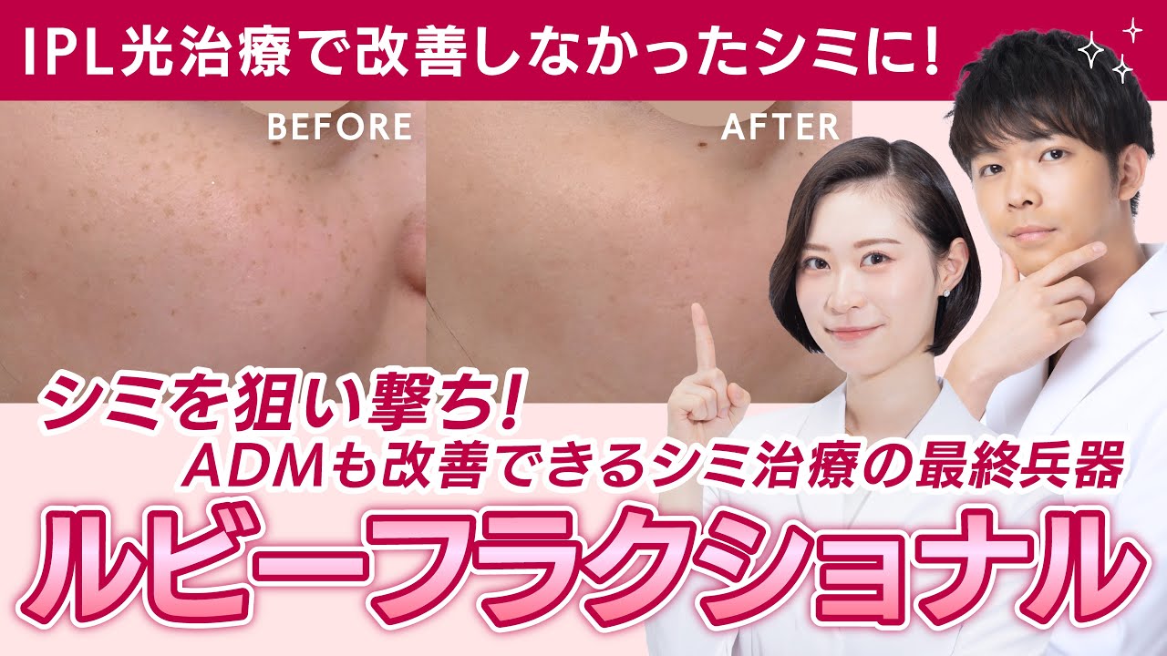 【シミ治療】効率もコスパも良い？！ルビーフラクショナル【徹底解説】