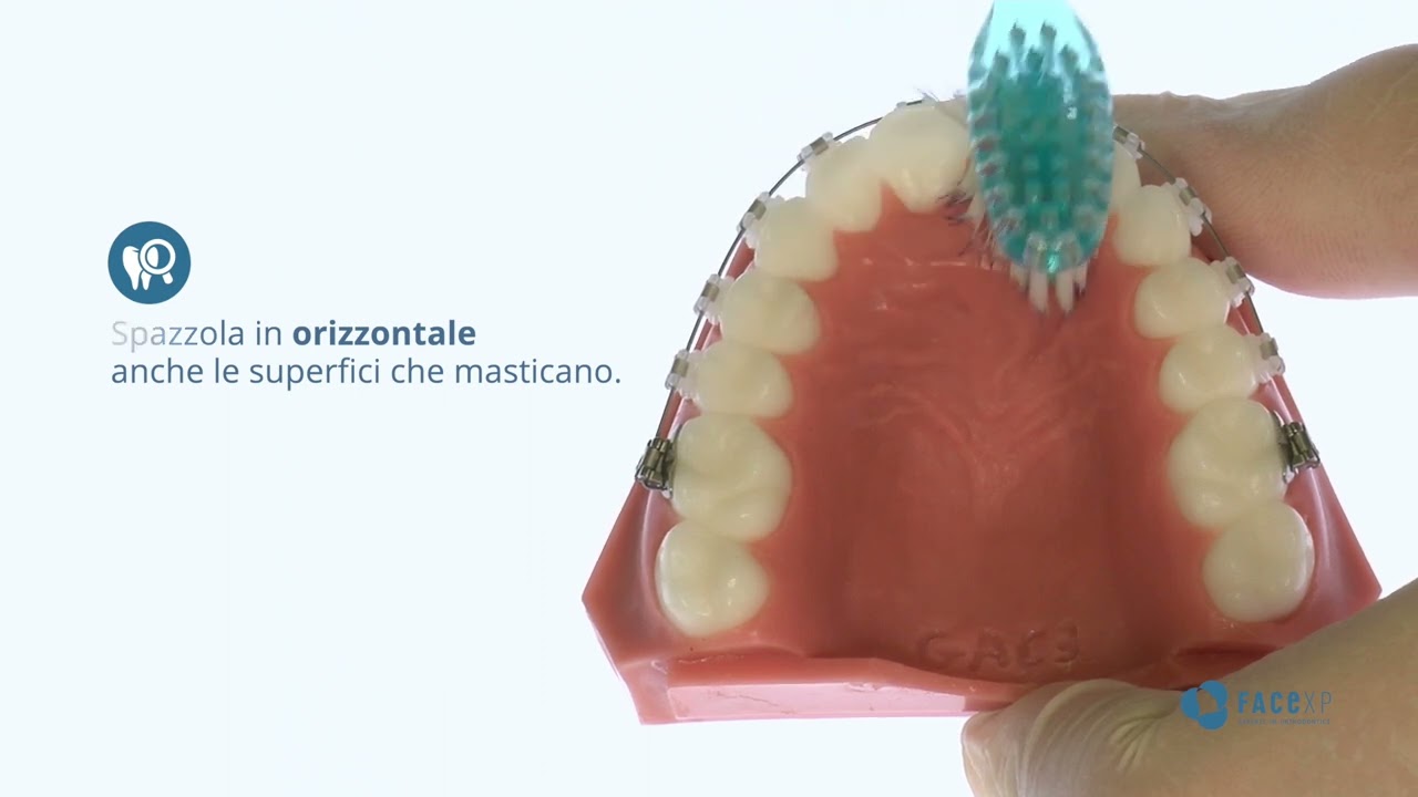 Tutorial Igiene Orale con Apparecchio Ortodontico