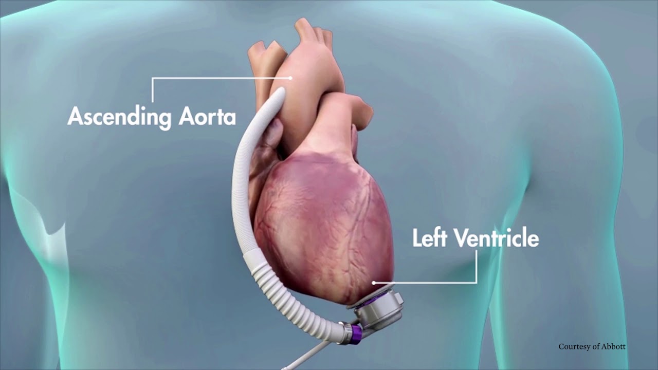 Treating Heart Failure with the Heartmate 3 LVAD