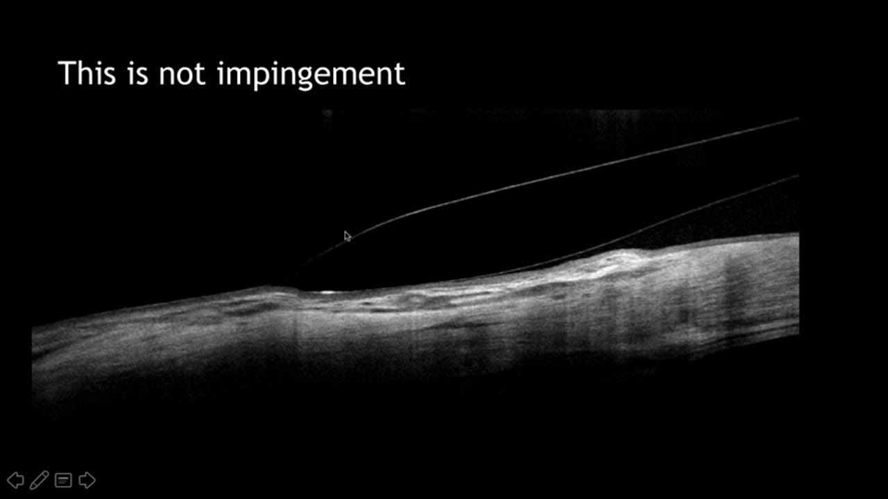 Anterior Segment & Contact Lens Applications of OCT