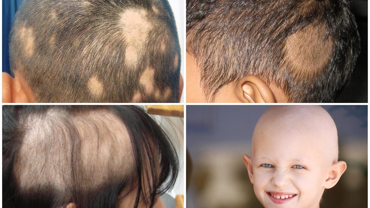 Pediatrik alopesiyalar / Uşaqlığın saç tökülmələri / Pediatrik dermatologiya