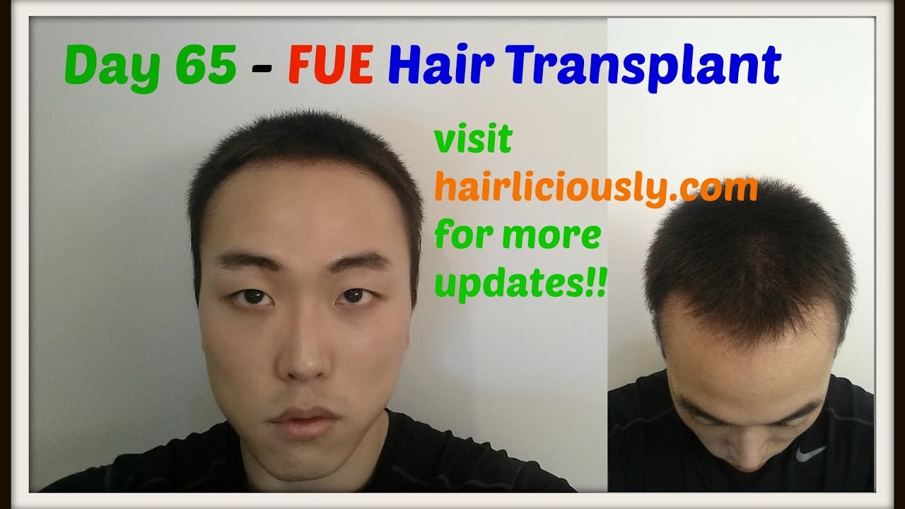 Day 65 - FUE Hair Transplant Surgery 1700 Grafts Results!!