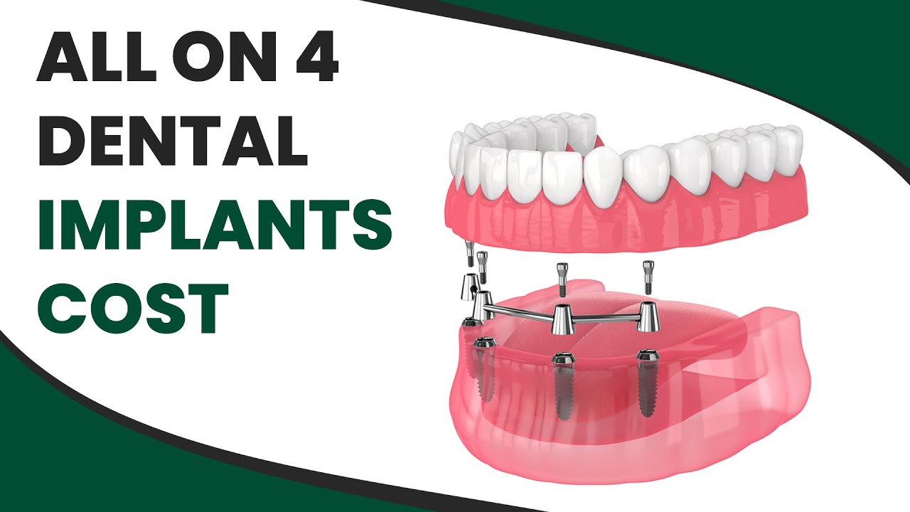 All On 4 Dental Implants Cost
