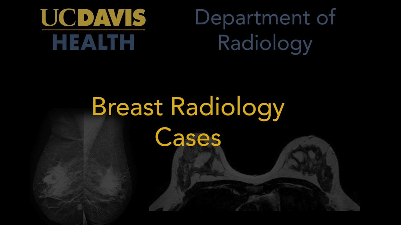 Breast calcification patterns: rim calcification