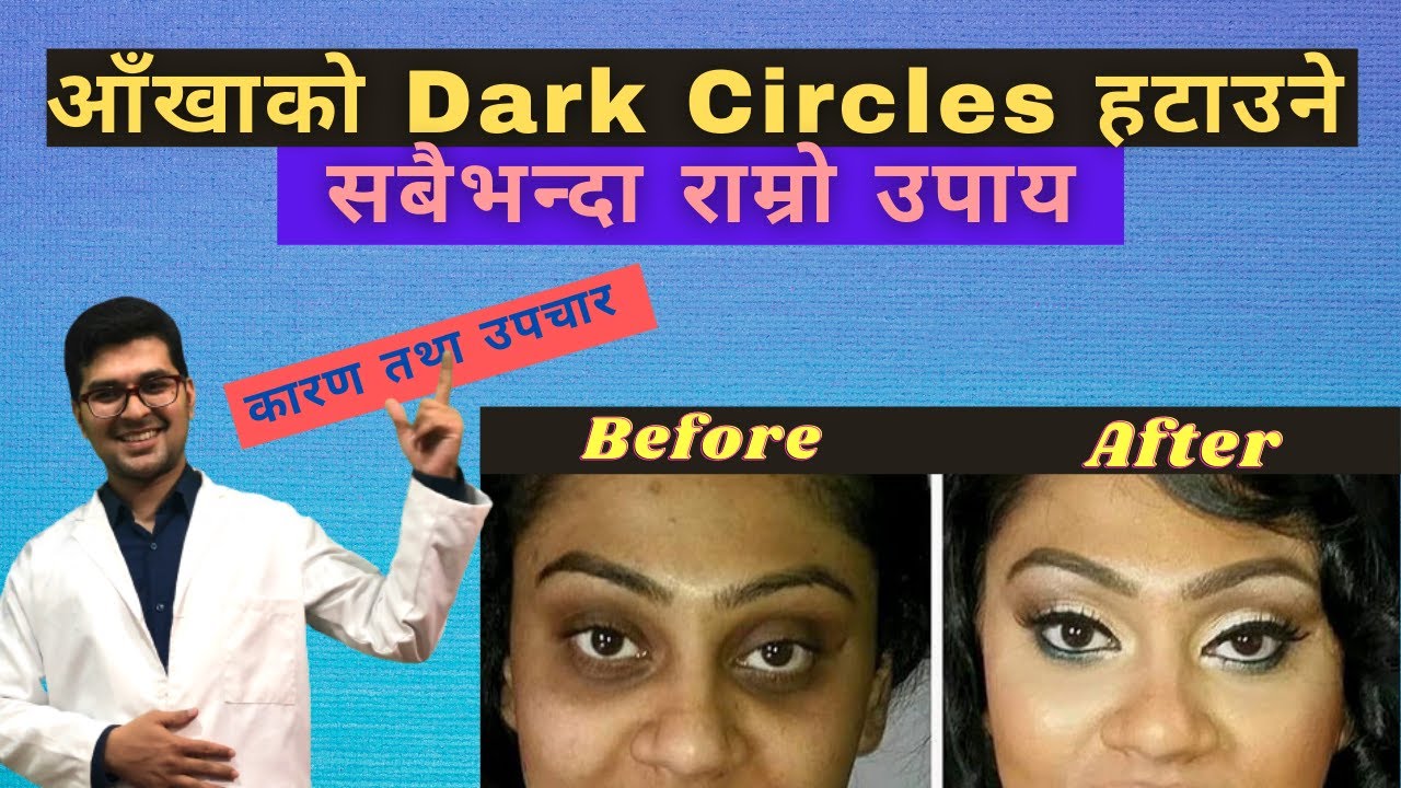 आँखाको  Dark Circles कसरी हटाउने ?|Best Treatment For Dark Circles| [Dermatologist's Advice]