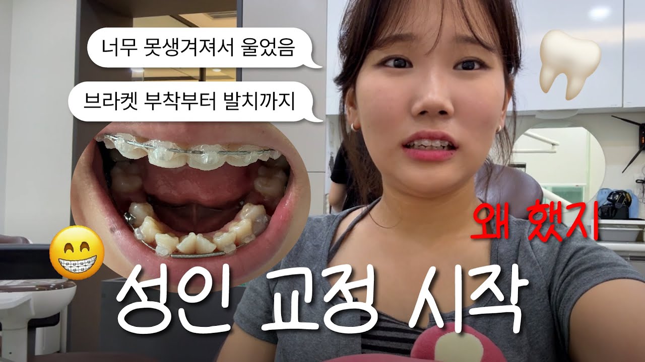 23살 치아 교정 시작 🦷 얼굴형 변화 · 발치? 비발치? · 데이몬 클리어 · 교정 주의사항