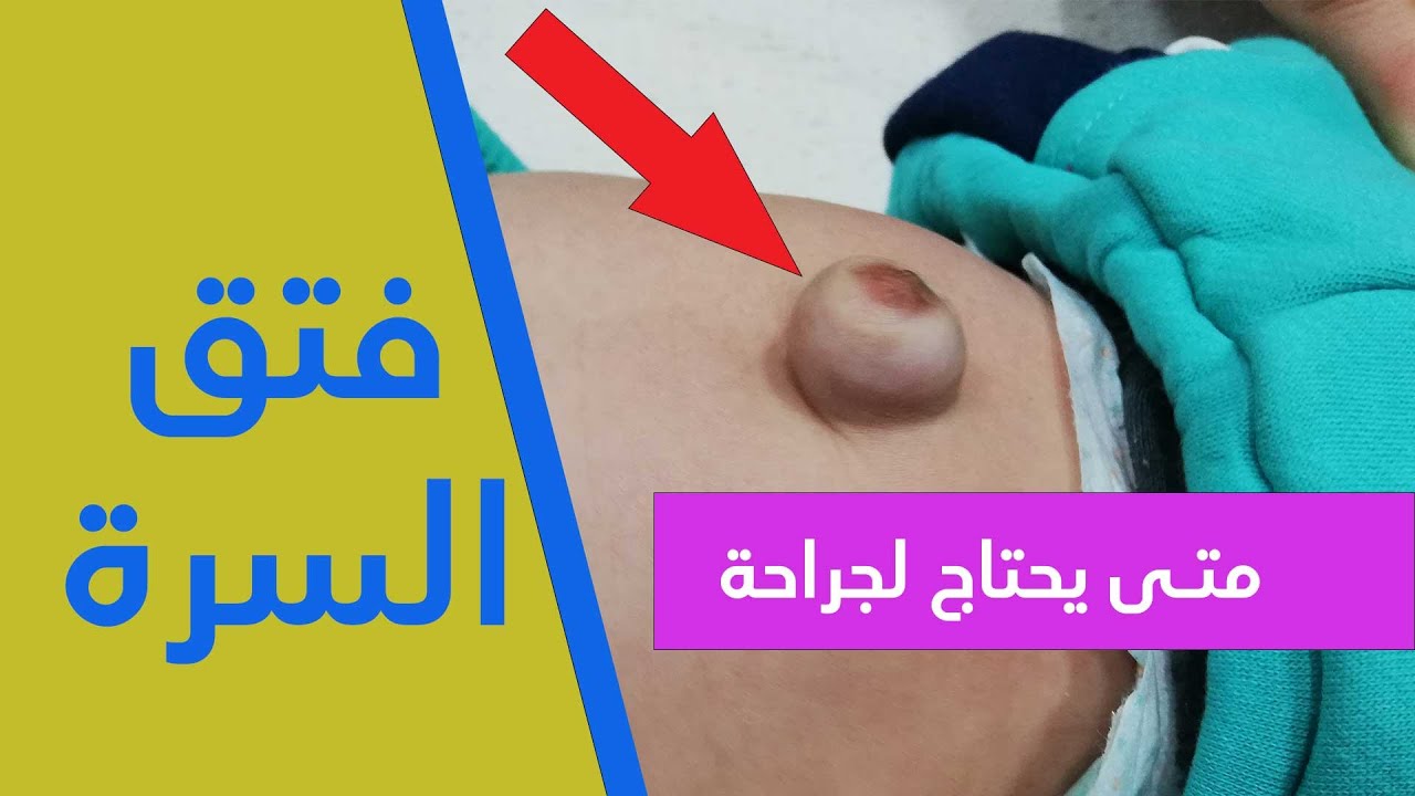 فتاق السرة  👈 متى يحتاج لعملية جراحية  ✅ الاجابة في الفيديو