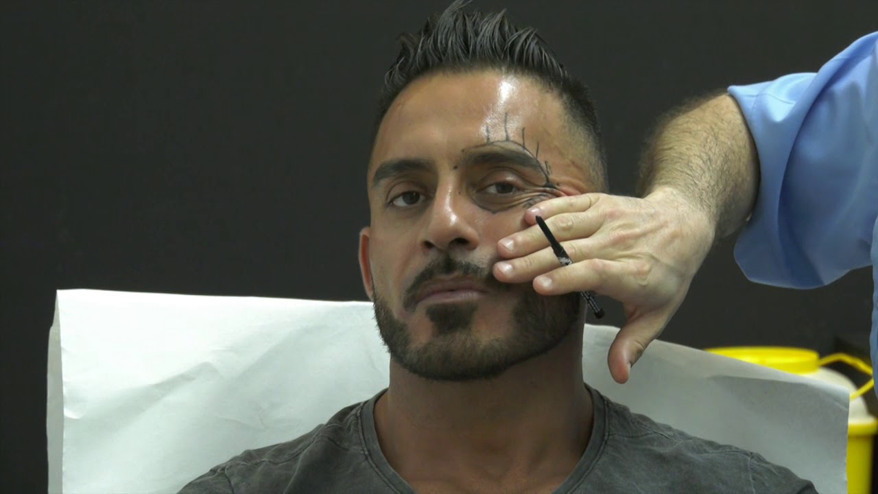 Técnica Athenea zona periocular en hombre.