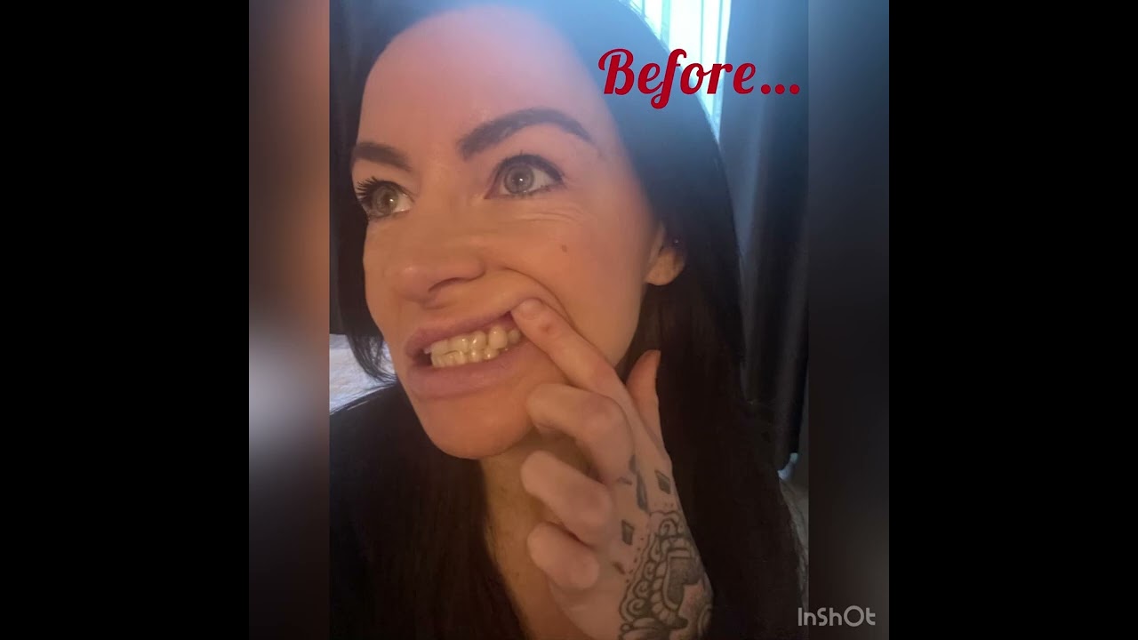 |Come with me to Turkey 🇹🇷 | Turkey teeth vlog, real honest raw video!|