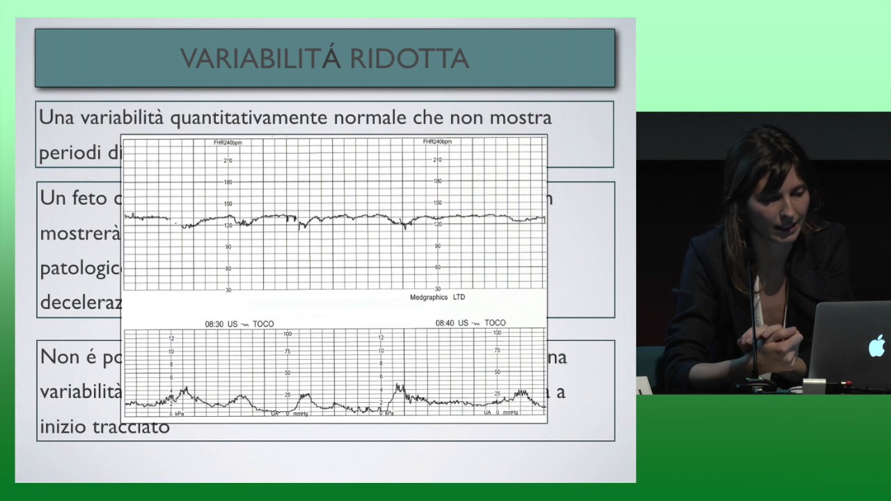 Fattori che possono interferire con l'interpretazione del tracciato CTG - Dott.ssa C. Businelli