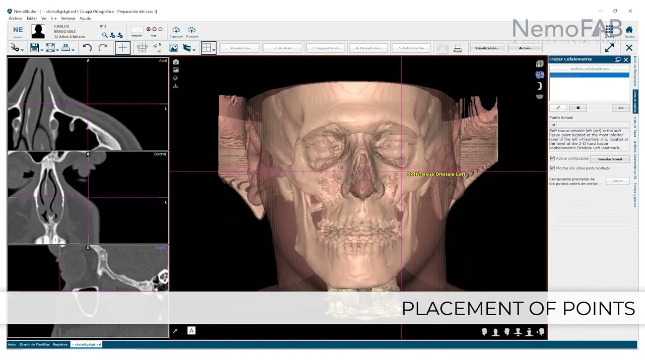NemoFAB Demo - Leading solution for orthognathic surgeons_English