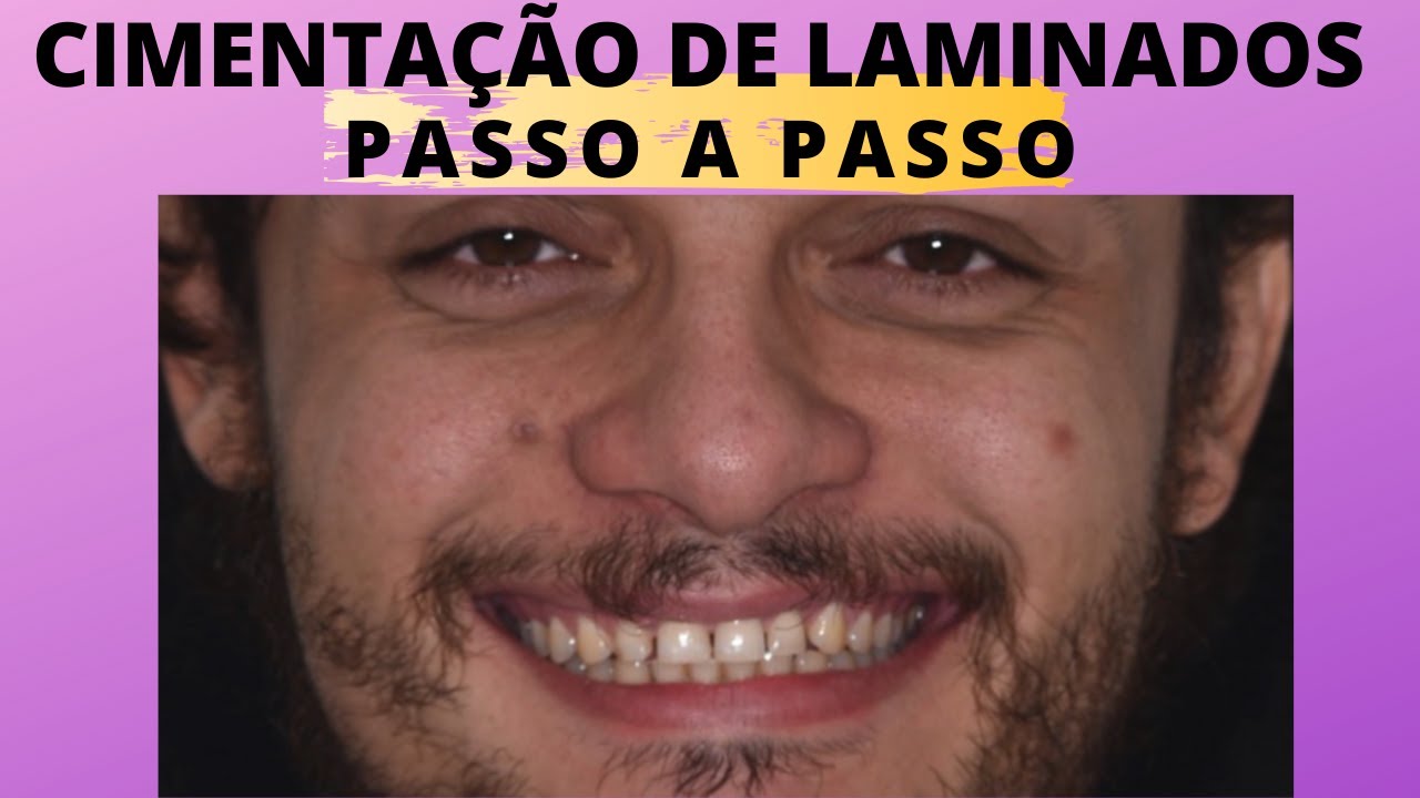 Cimenta&ccedil;&atilde;o de laminados - Passo a Passo