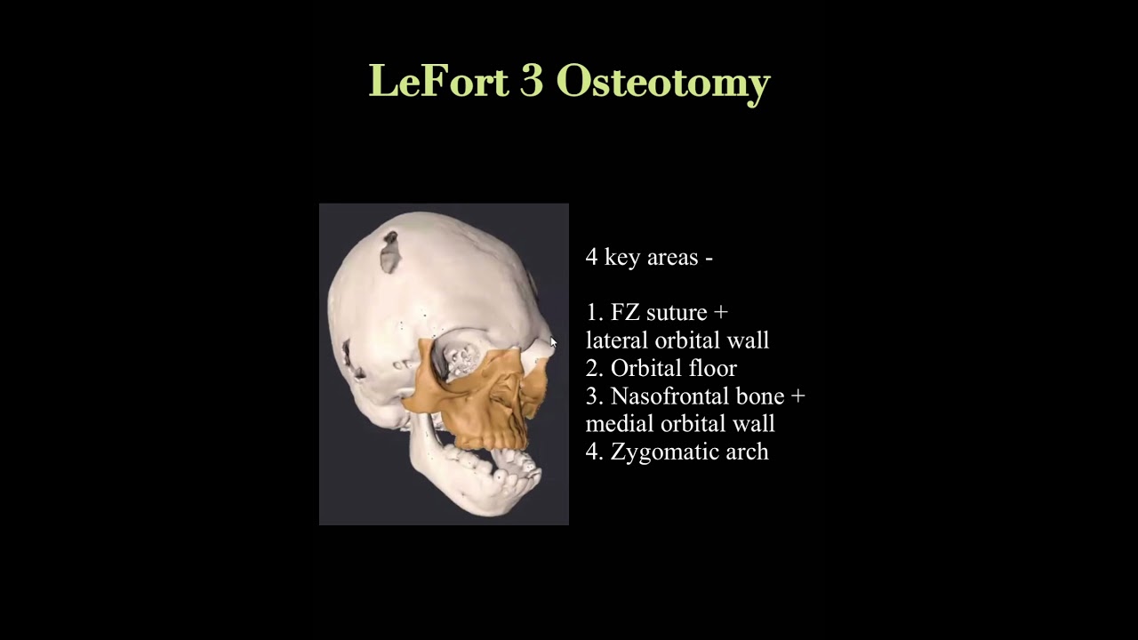 #Webinar LeFort 3 Osteotomy and Minimally Invasive Craniofacial Surgery with Dr Vercruysse