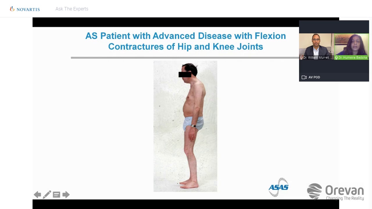 Back pain from Ankylosing Spondylitis or Seronegative Spondyloarthritis