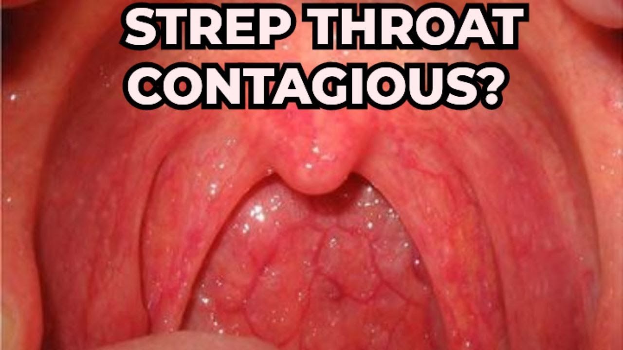 Is Strep Throat Contagious? Everything You Need to Know!