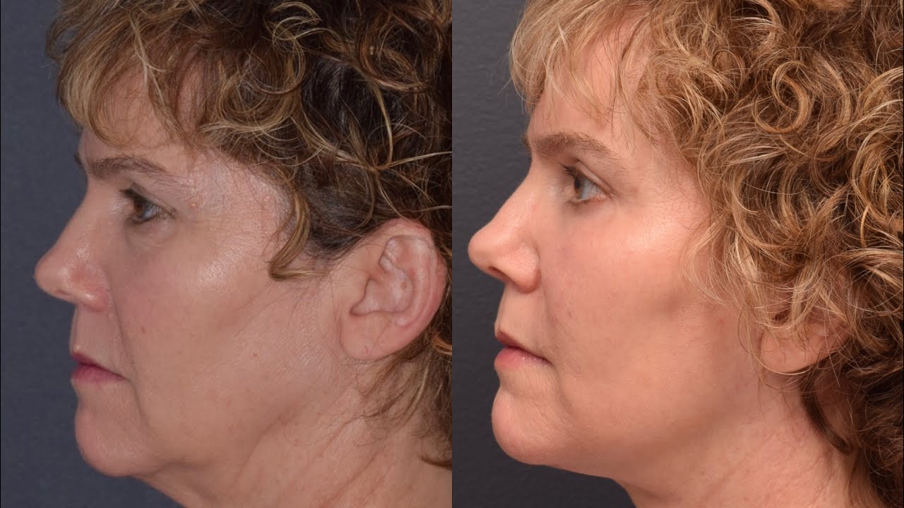 Facelift & Necklift Patient Testimonial