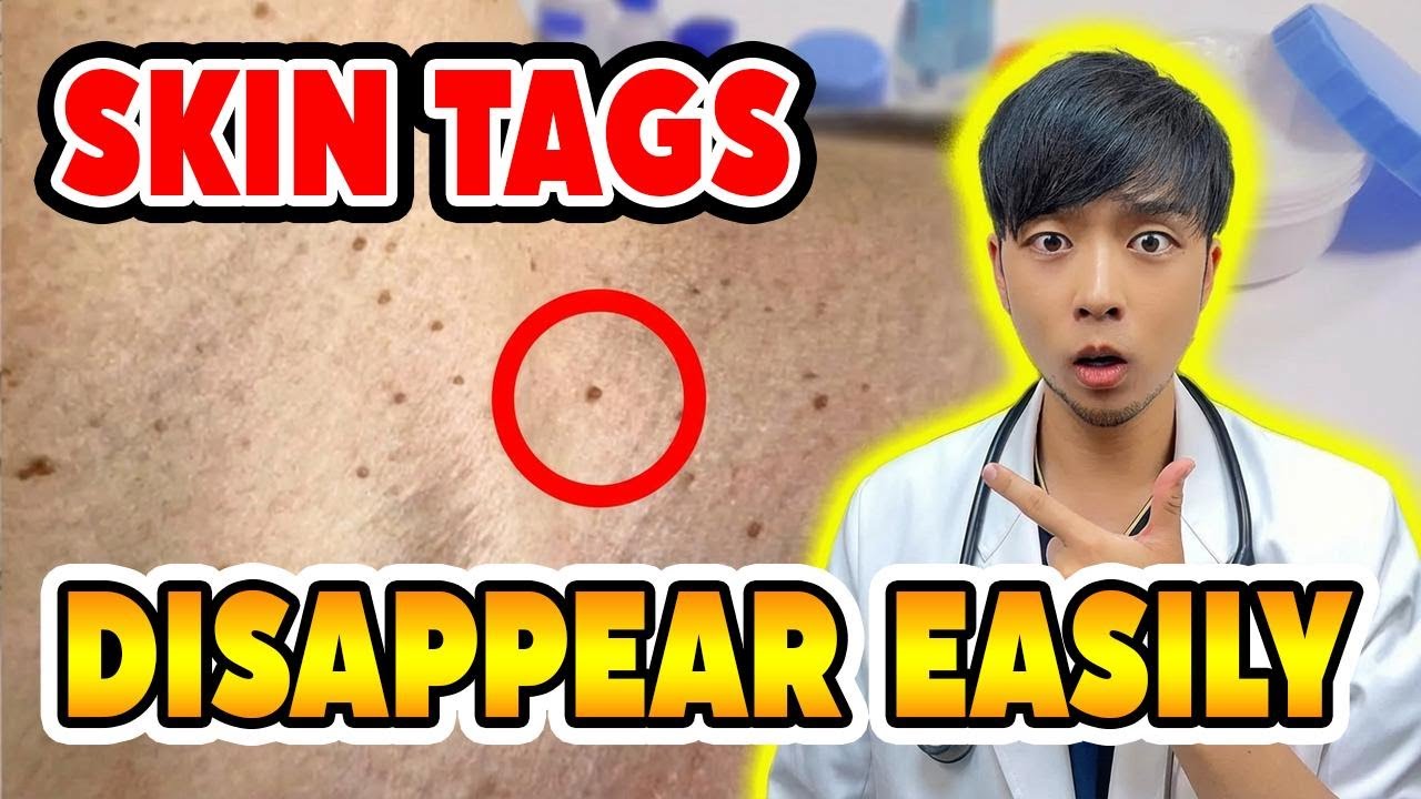 Can You Really Get Rid of Neck Skin Tags This Easily? My Honest Experience!