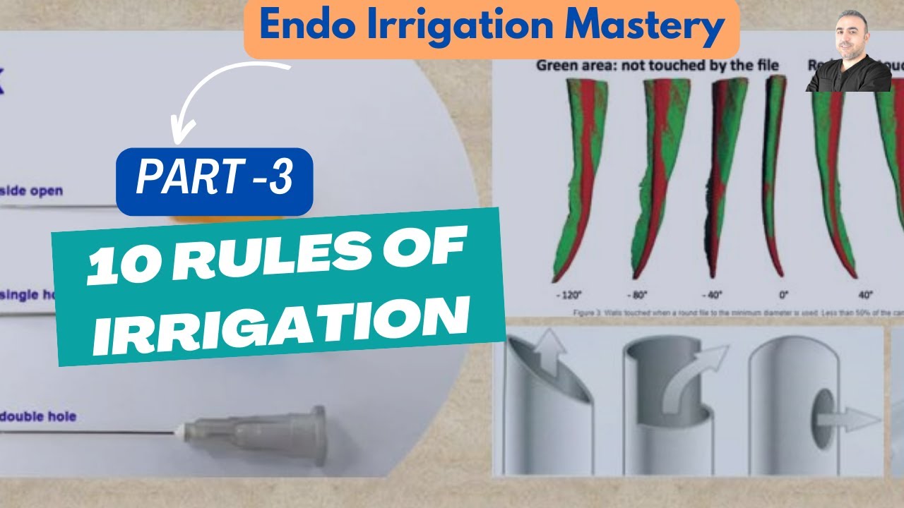 3- سلسلة إتقان إرواء الجذور - تحديات التنشيط وأهم 10 قواعد للإرواء / Top Ten Endo Irrigation Rules