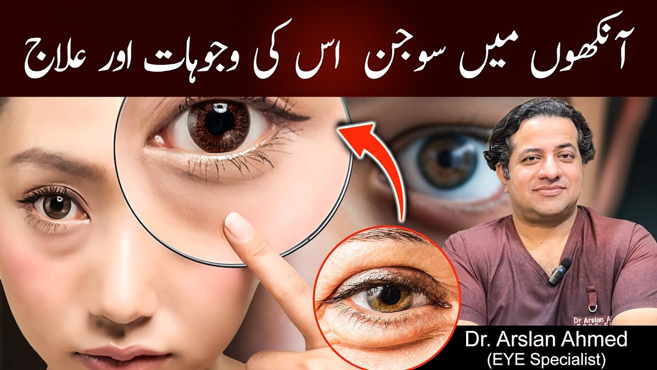 Puffy Eyes Treatment in Urdu/Hindi | How To Get Rid Of Eye Bags