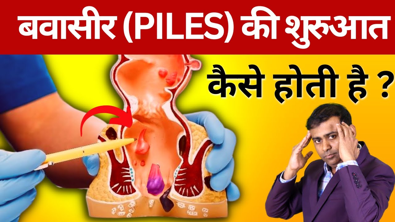 शरीर में बवासीर (piles) की शुरुआत कैसे होती है ? 10  कारण #piles #pilestreatment #pilesdoctor
