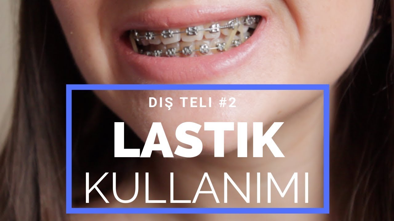 Diş Teli Sürecim #2 | Lastik Takımı ve Kullanımı | Safiye Elmas