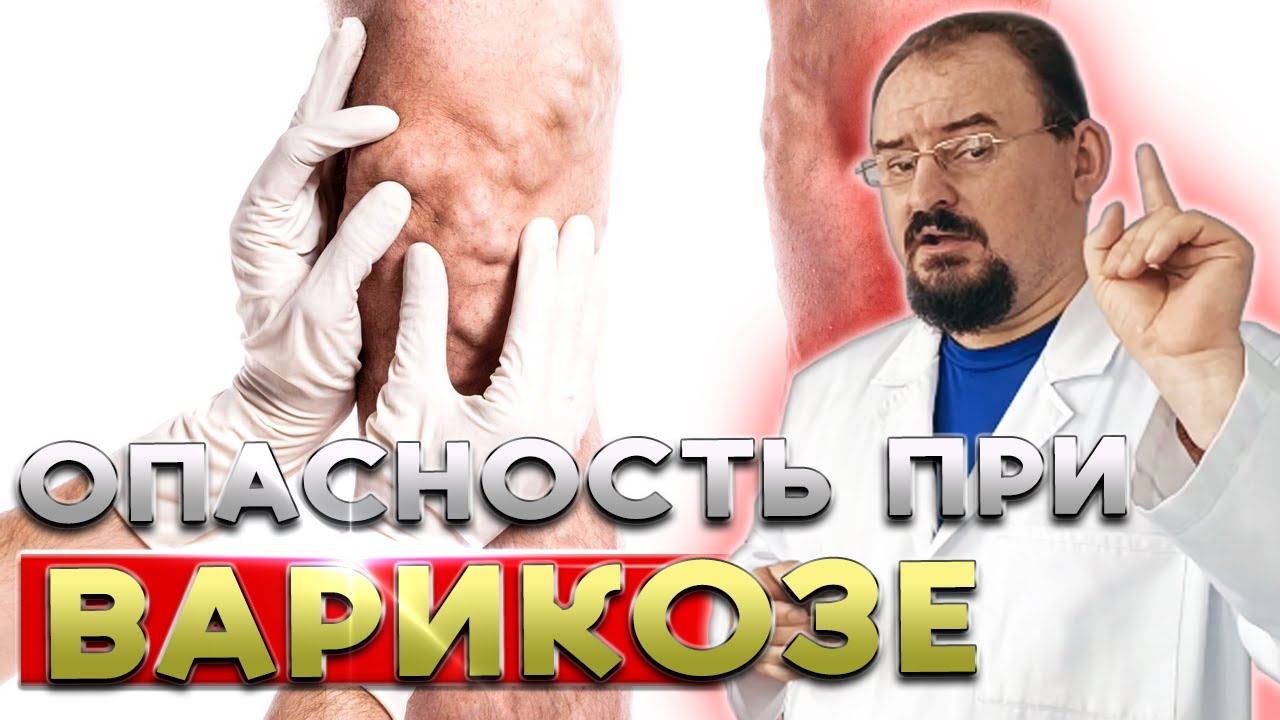 Варикоз — Опасный Сигнал! Как Избавиться от Вен Навсегда?