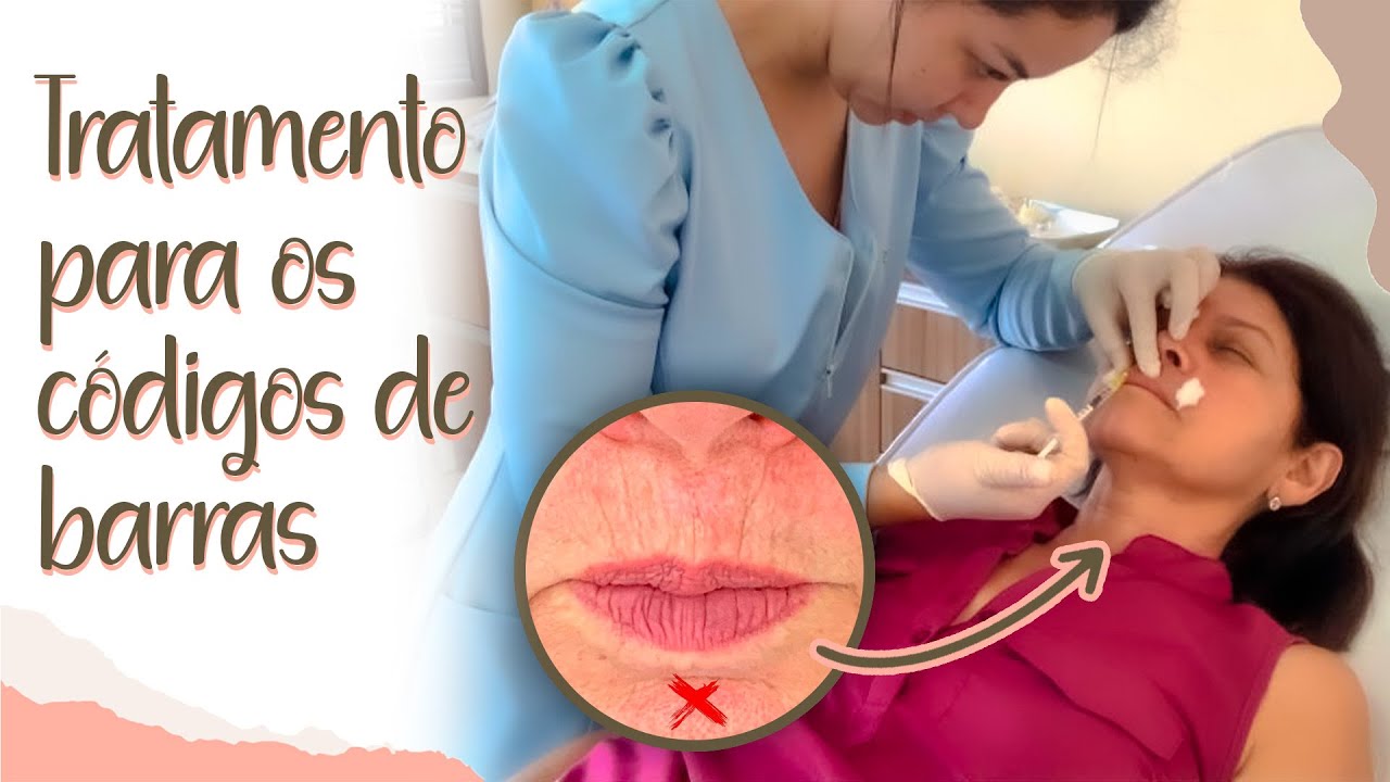 RUGAS AO REDOR DOS LÁBIOS? Conheça o tratamento para os CÓDIGOS DE BARRAS! #skinbooster