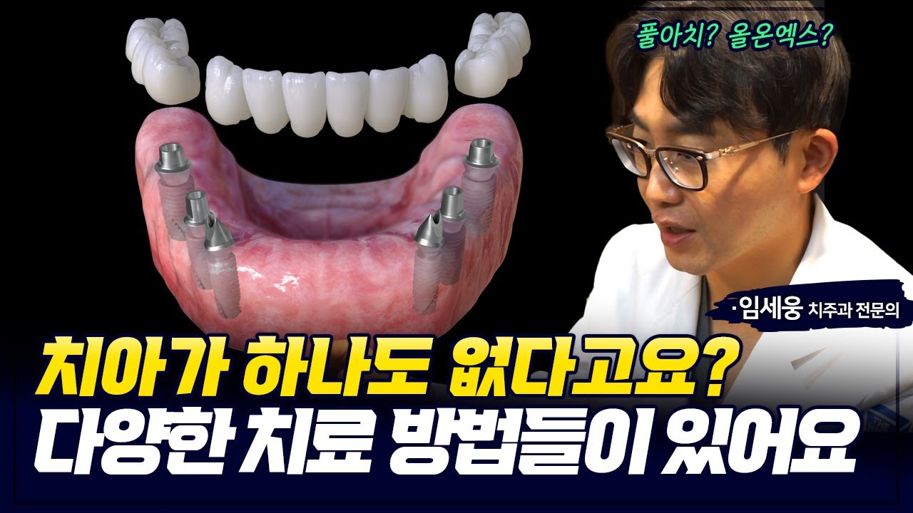 전체임플란트 불가능 한 경우는 없습니다 ft.풀아치 & 올온엑스