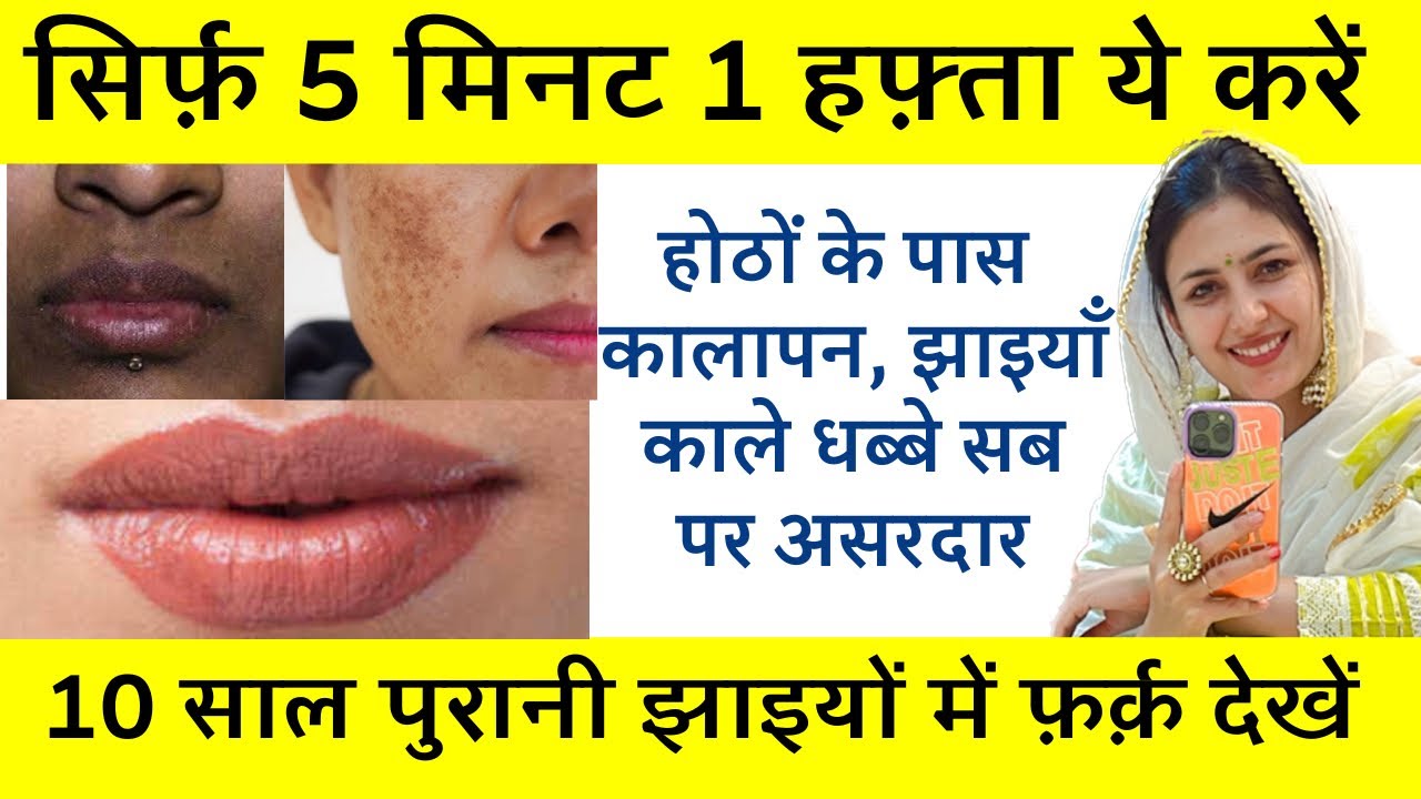 Remove Dark Black Patches around mouth | Pigmentation Melasma Dark Spots Remedy | Dr. Upasana Vohra