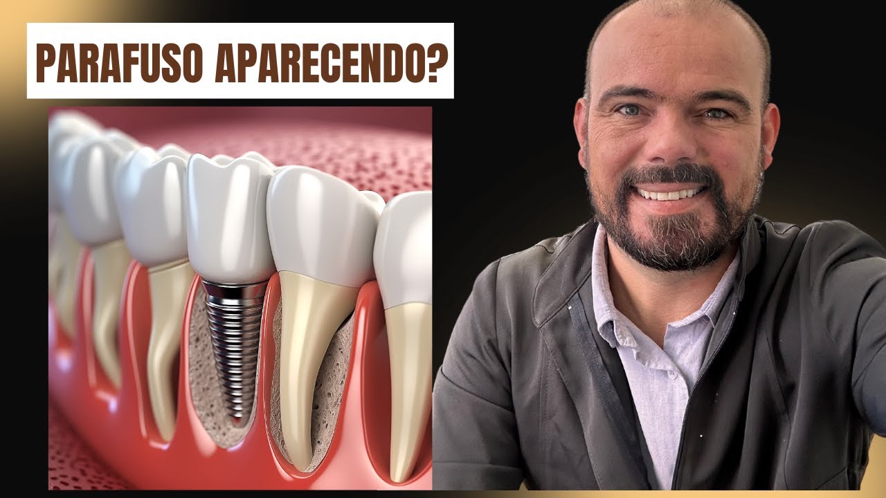 O IMPLANTE DENTÁRIO  está aparecendo na GENGIVA ?