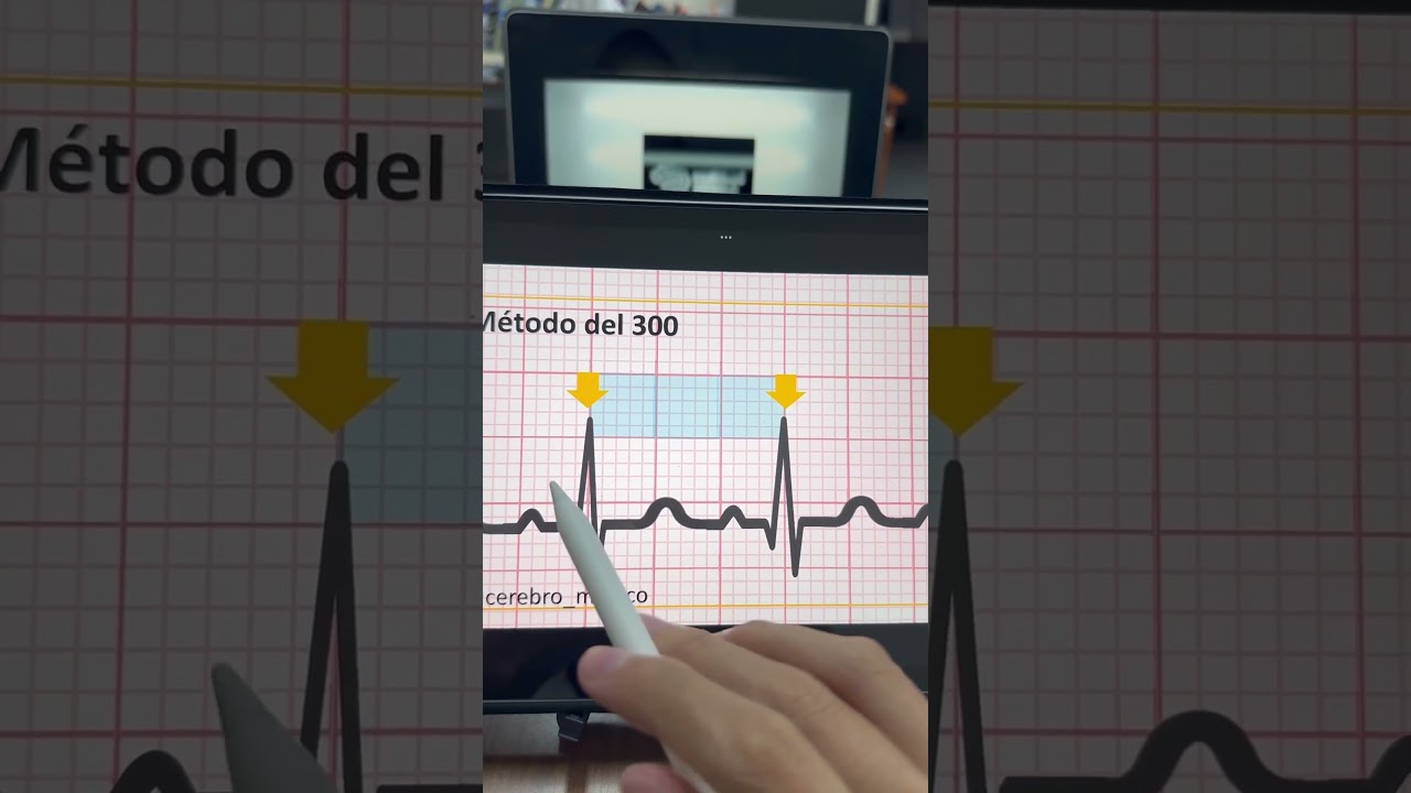 C&oacute;mo calcular la FC en el ECG #medicina