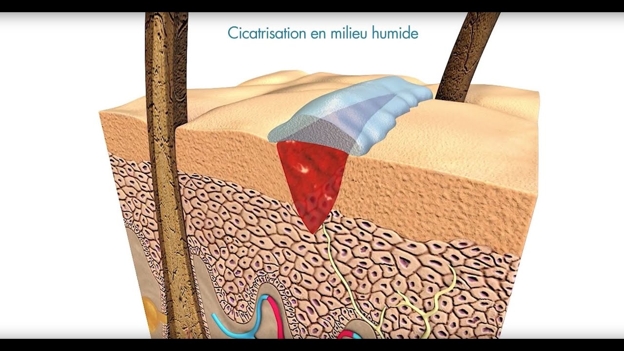 Flamigel | Soin des plaies en milieu humide avec Flamigel