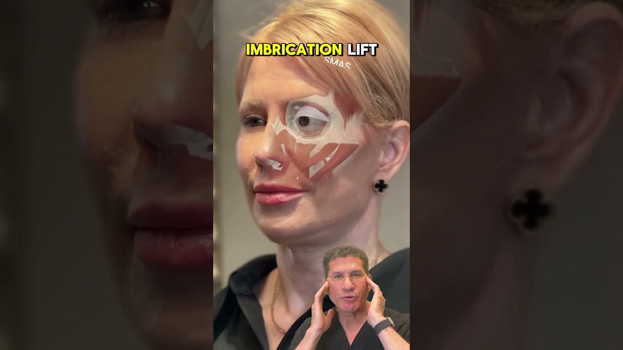 From Pillow Face to Snatched: Why the MicroLift Is the Filler Fix You Need