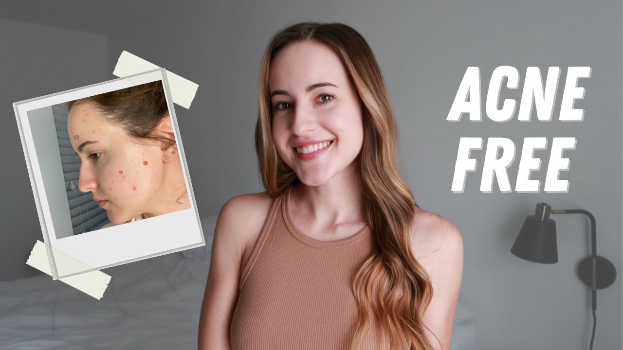 I QUIT DAIRY for 3 months and it CURED MY ACNE! My experience with dairy & acne...