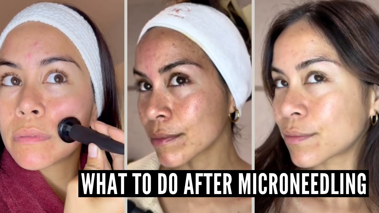 8 Important Microneedling Aftercare Tips YOU MUST KNOW