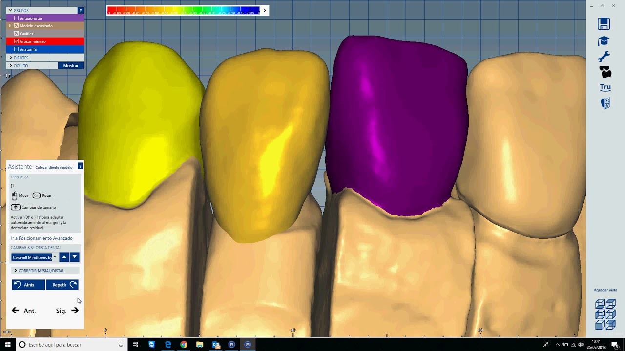 Como diseñar Corona con Cutback (EXOCAD)
