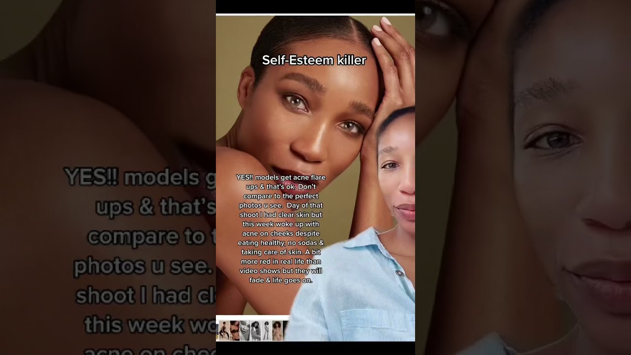 The reality of acne flare-ups even for models. Skincare