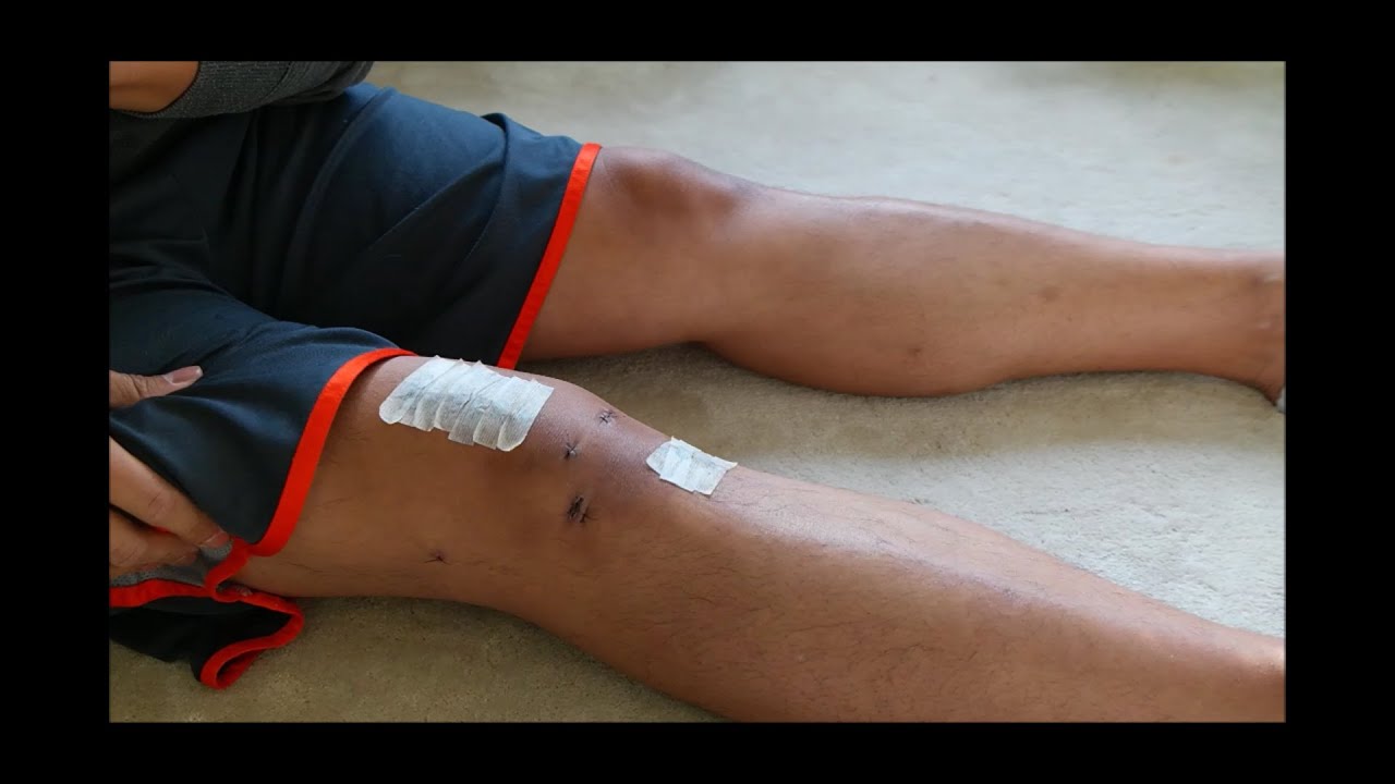 My ACL Surgery Recovery, Quadriceps Tendon Graft - Part 3 (2 Weeks)