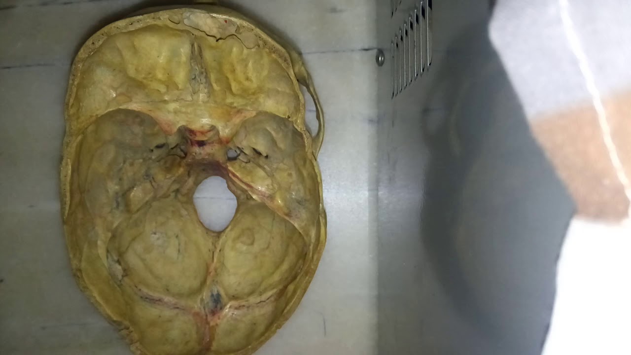 SKULL easieast MIDDLE CRANIAL FOSSA