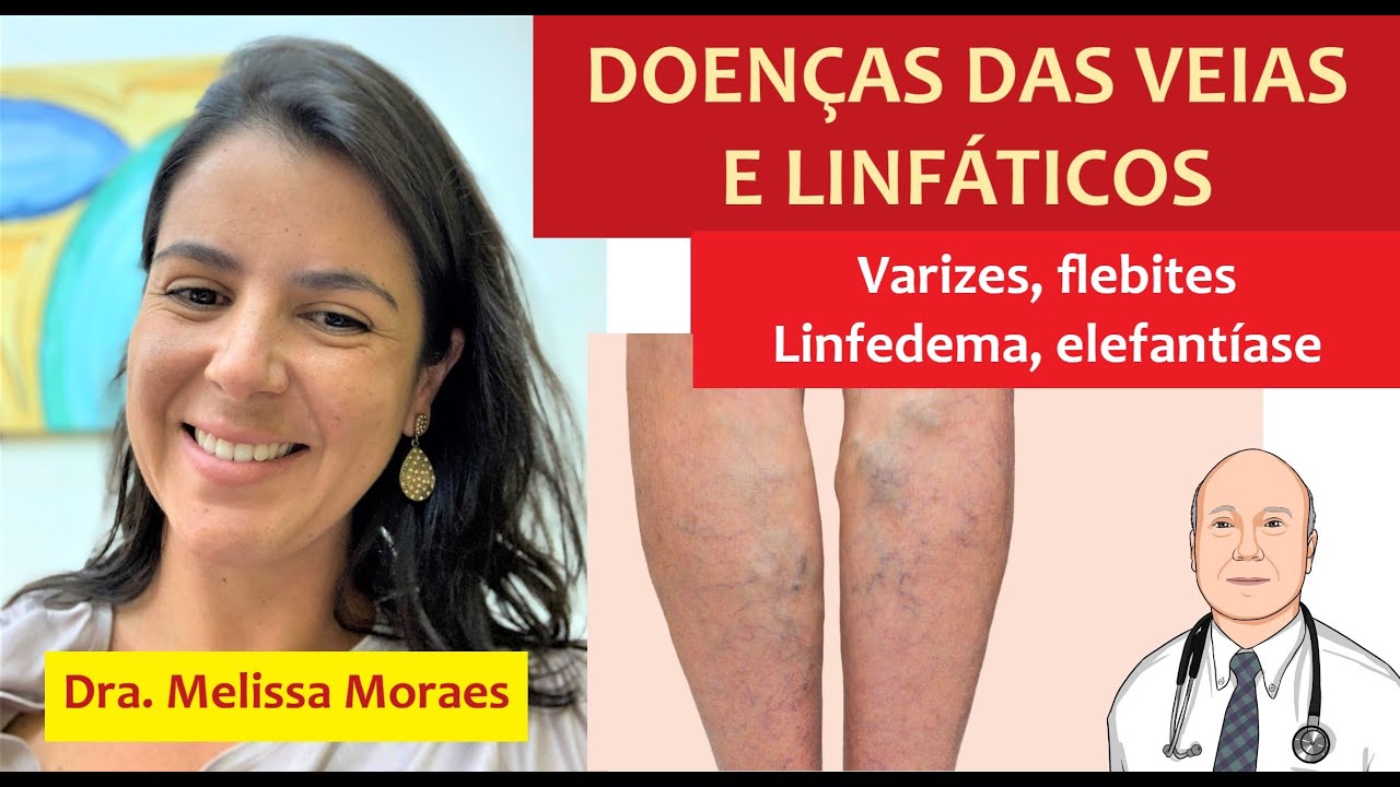 Problemas nas veias e linfáticos: varizes, tromboses, feridas e erisipela. Sintomas e tratamento.