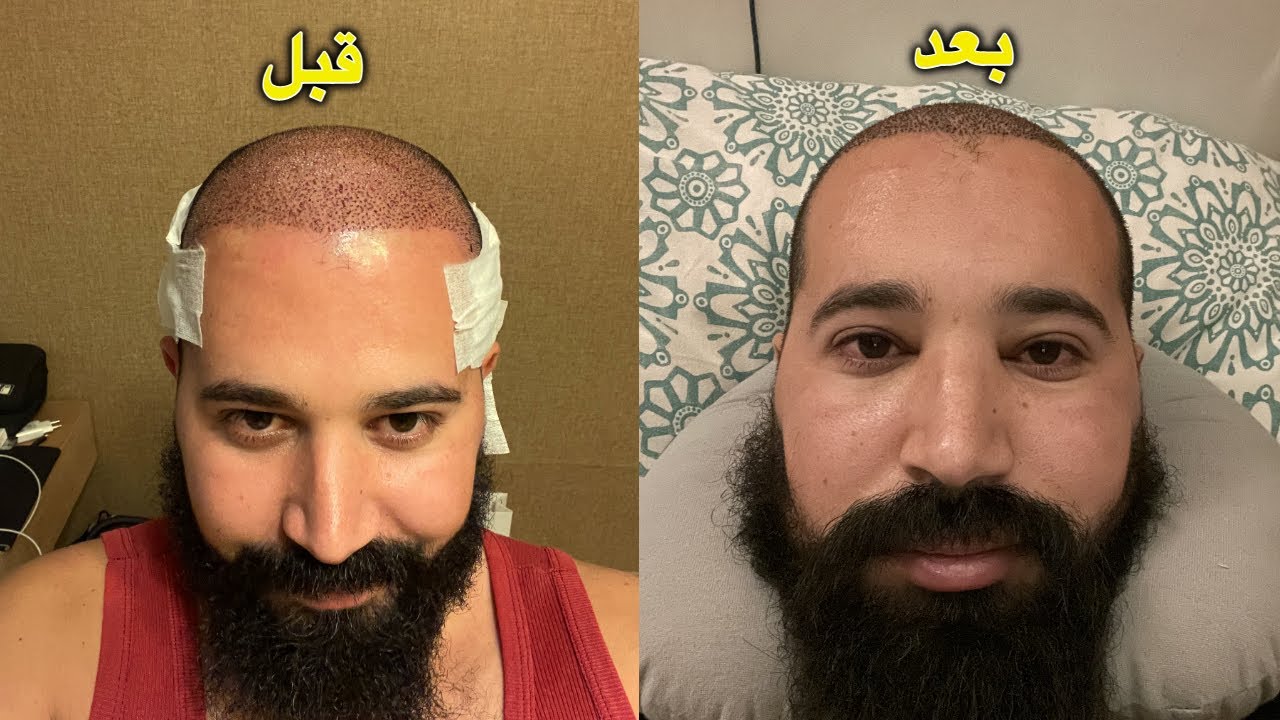 أشياء يجب عليك معرفتها قبل زراعة الشعر في تركيا